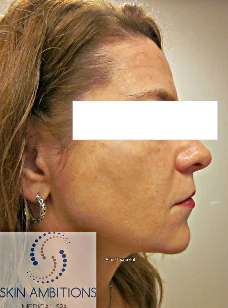 Facial Contouring Skin Ambitions